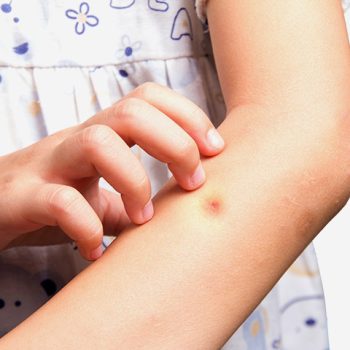 szuunyog 2 5 házi praktika, hogy elűzd a szúnyogokat